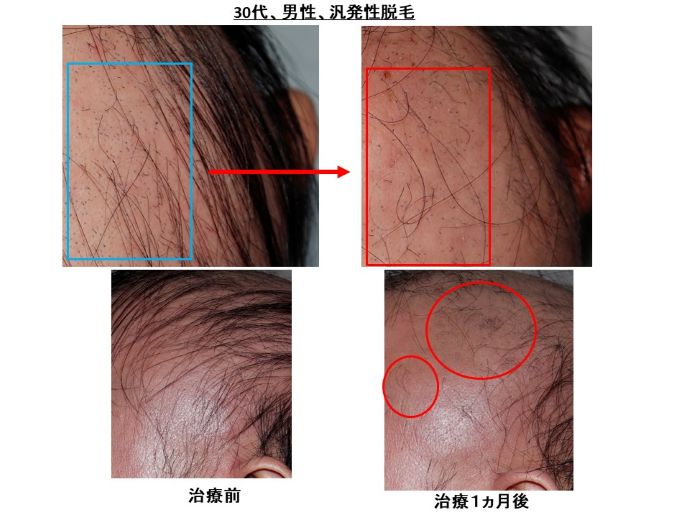 円形脱毛症　病院